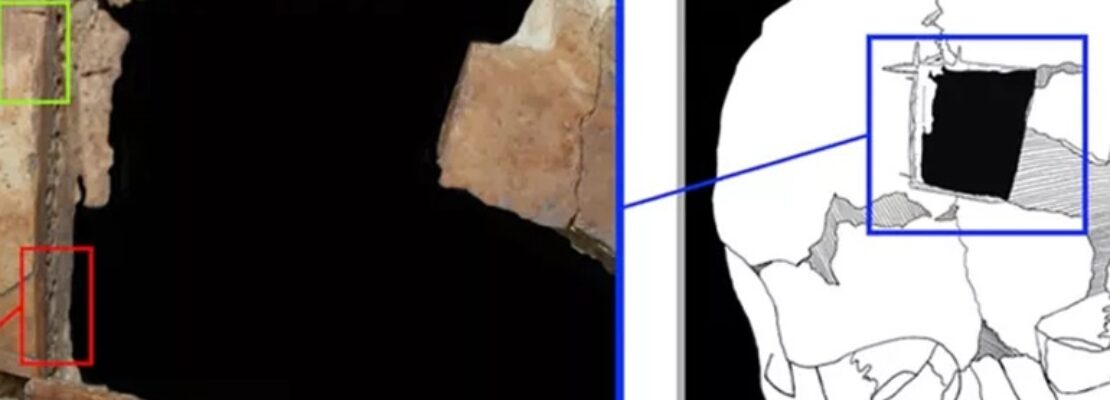 Άνθρωπος με τετράγωνη τρύπα στο κρανίο του – Ένδειξη για χειρουργική εγκεφάλου πριν 3.500 χρόνια στο Ισραήλ